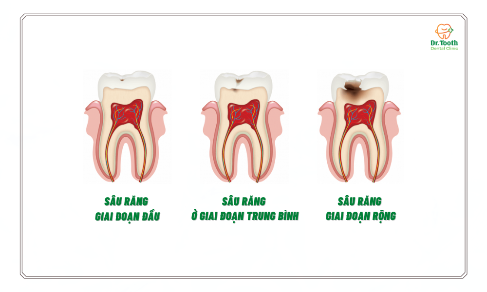 Sâu răng có nguy hiểm không?