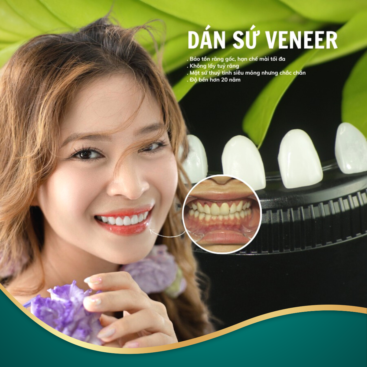 dán sứ veneer (3)