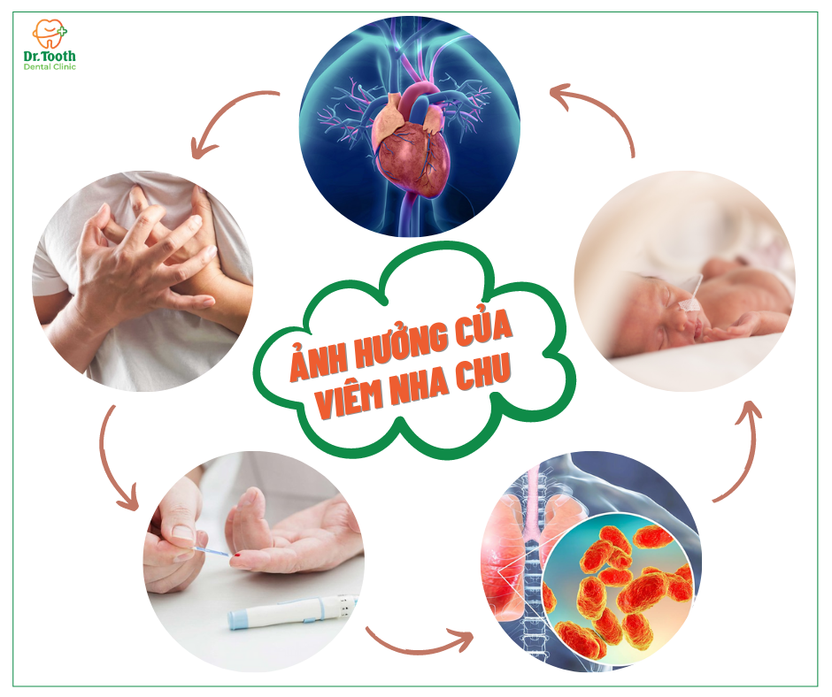 Bệnh nha chu ảnh hưởng đến sức khỏe tổng thể của bạn như thế nào?