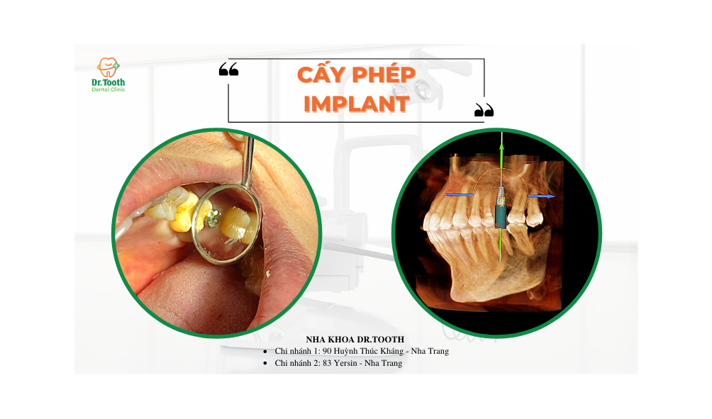 Trồng răng – cấy ghép Implant