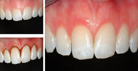 Laser - A new trend in dental value