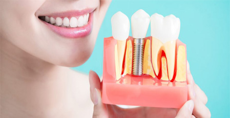 Method implants (implants) Instant Dental for teeth