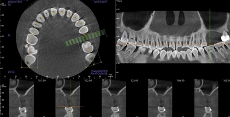 Advantages of Cone beam CT over Panorama film