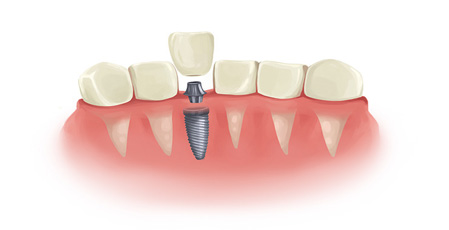 6 tips for looking after your implants