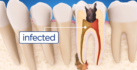 Dental Cysts: What Are They and How They Can Be Prevented?