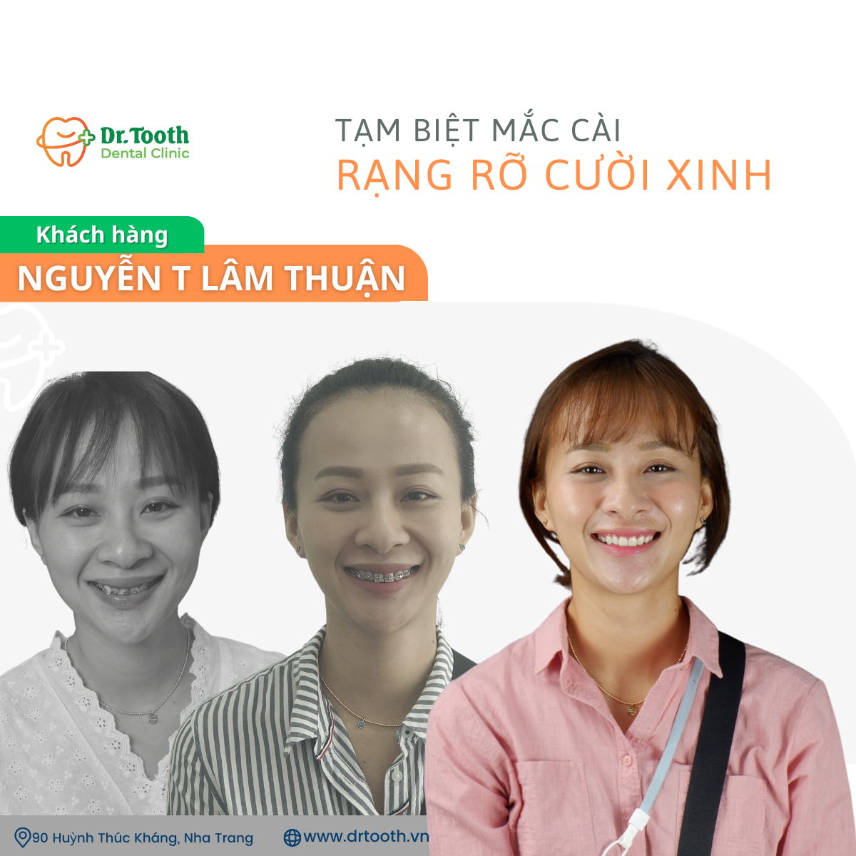 niềng răng nha trang (2)