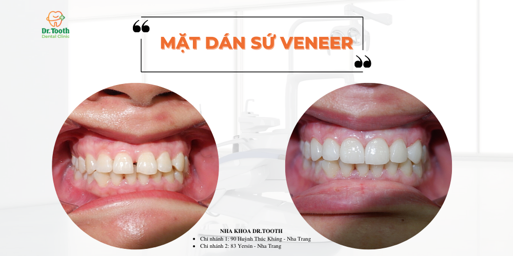 Mặt dán sứ veneer là gì?