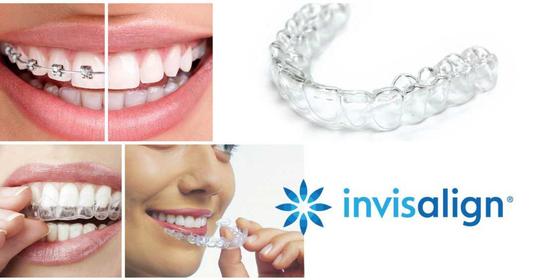 kapos-invisalign