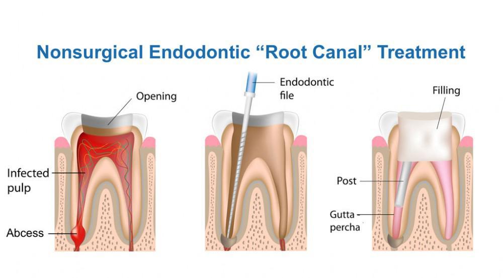 root canal treatment