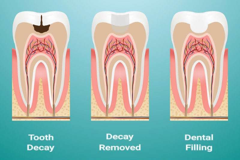 tooth-filling
