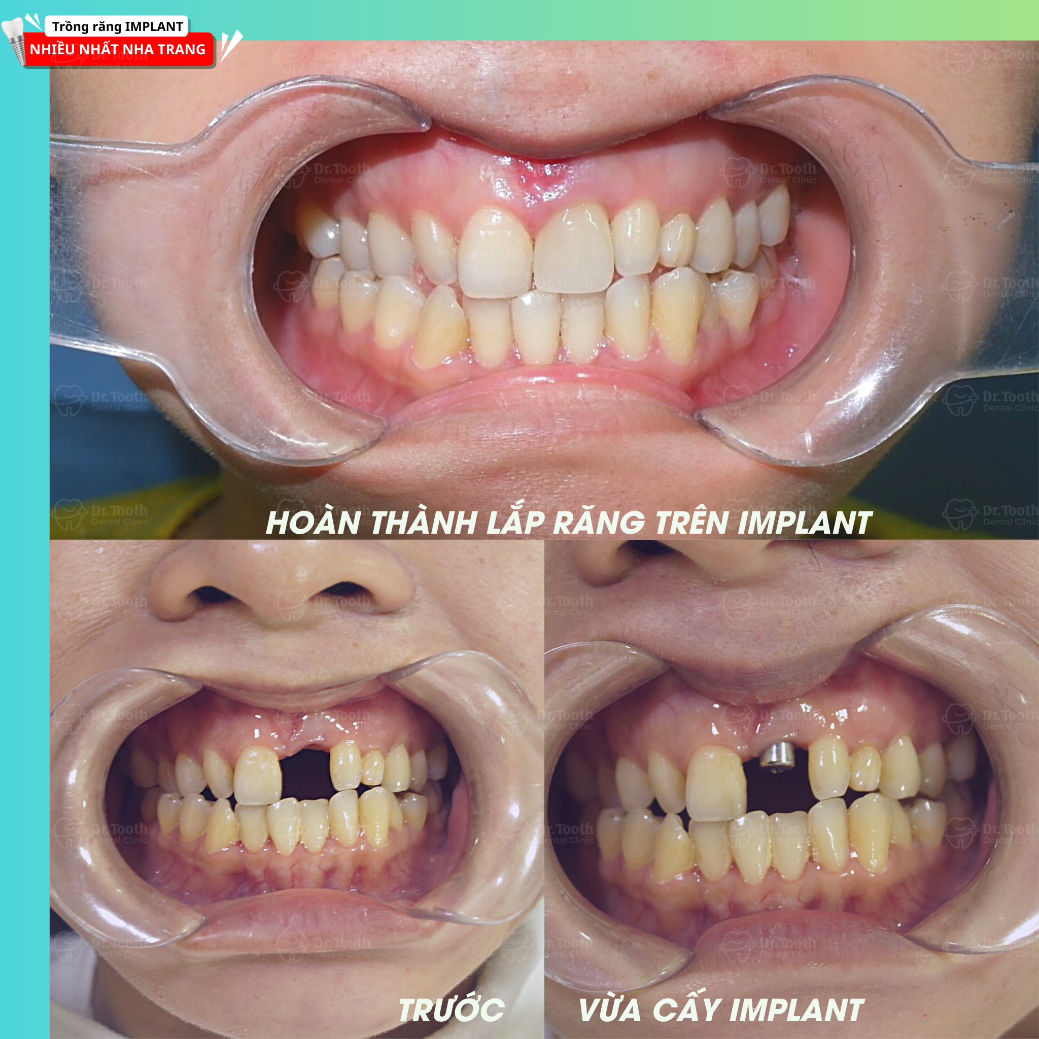 trồng răng implant